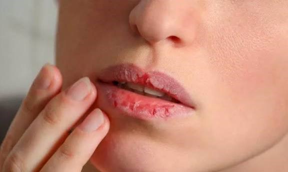 Jangan Dijilat! Ini 5 Cara Ampuh Atasi Bibir Pecah-Pecah Saat Menjalankan Puasa