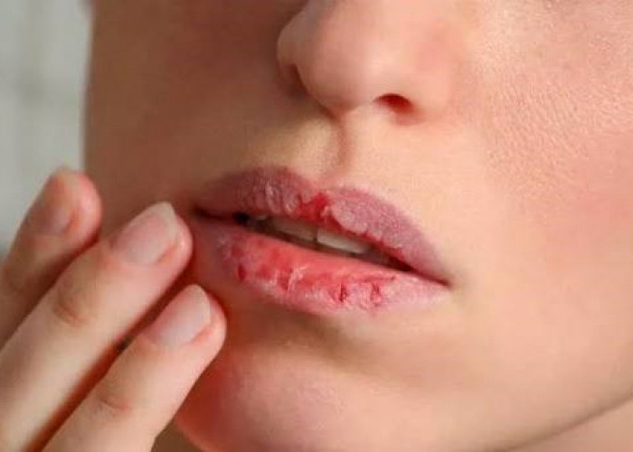 Jangan Dijilat! Ini 5 Cara Ampuh Atasi Bibir Pecah-Pecah Saat Menjalankan Puasa