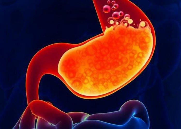 Kiat-Kiat Menjaga Tubuh bagi Penderita GERD Agar Tidak Kambuh 