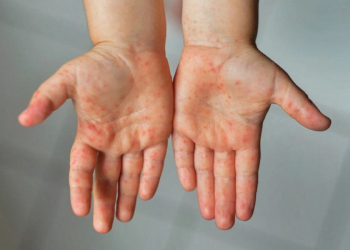 Alarm Kewaspadaan Campak: Kemenkes Perketat Proteksi Tenaga Medis di Garda Terdepan