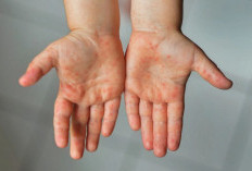 Alarm Kewaspadaan Campak: Kemenkes Perketat Proteksi Tenaga Medis di Garda Terdepan